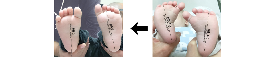 כפות רגלי תינוקות מעוותות בגלל מטטרסוס אדוקטוס